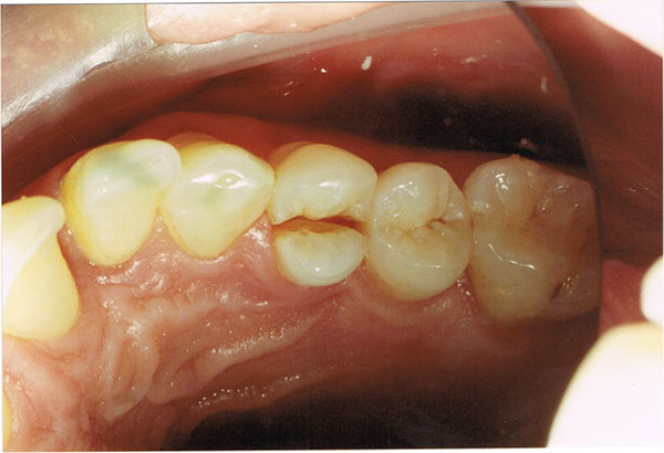 fixing a chipped tooth sydney holistic dental centre crack teeth
