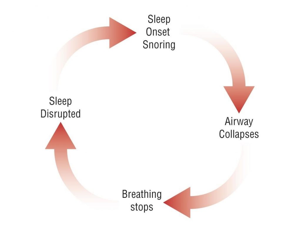 Snoring &#038; Obstructive Sleep Apnoea