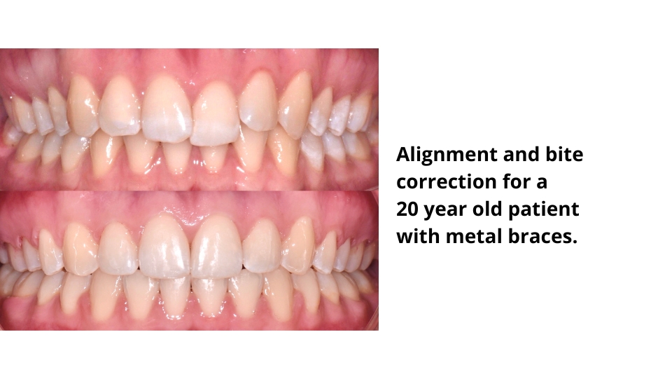 Orthodontics bite correction metal braces