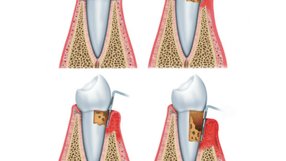 Gum Disease: The Good, The Bad, The Ugly and The Very Ugly