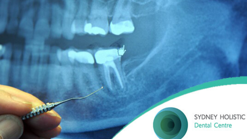 Root Canal Therapy and Cancer: A Holistic Dentists Opinion