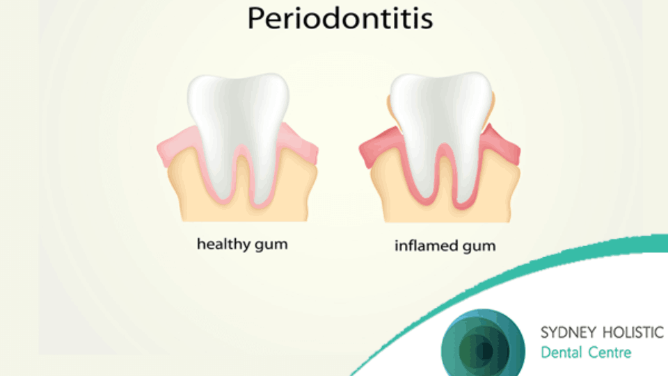 periodontitis explained