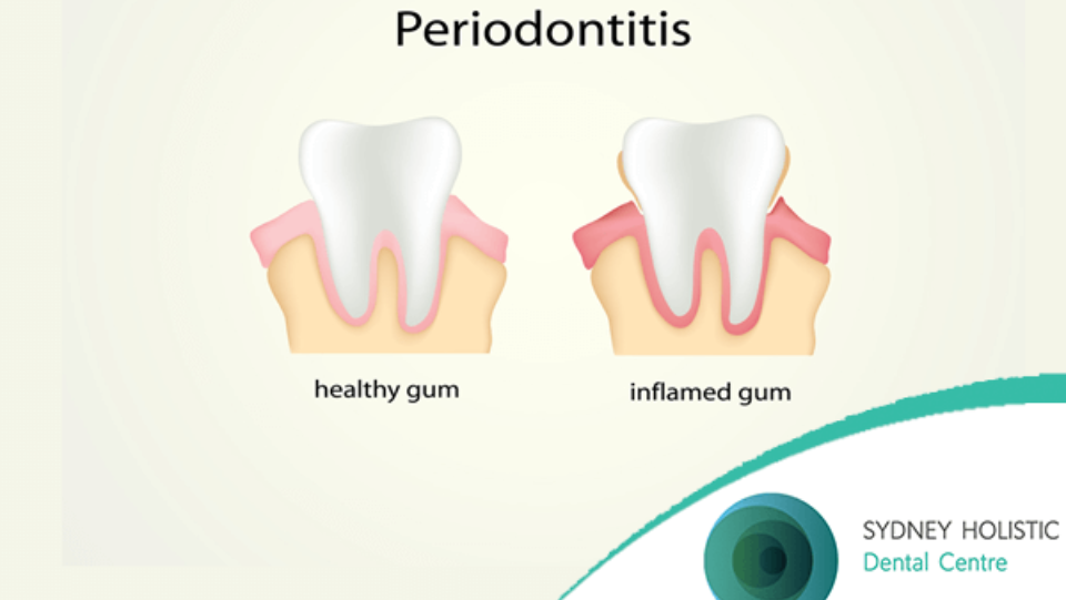 Controlling Periodontal Disease Through Diet