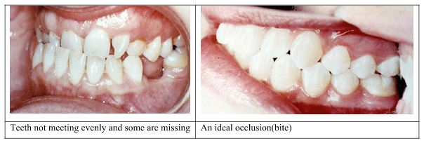 Chewing teeth