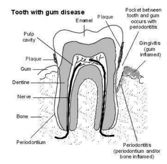 Why Gum Disease Matters
