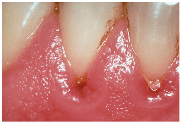 Why Gum Disease Matters