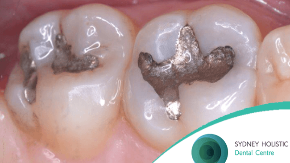 Dental Mercury Amalgam Fillings: An Environmental and Health Issue