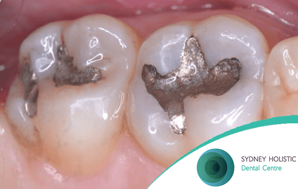 Amalgam filling removal