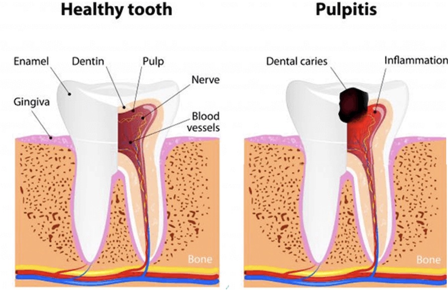 Tooth Decay