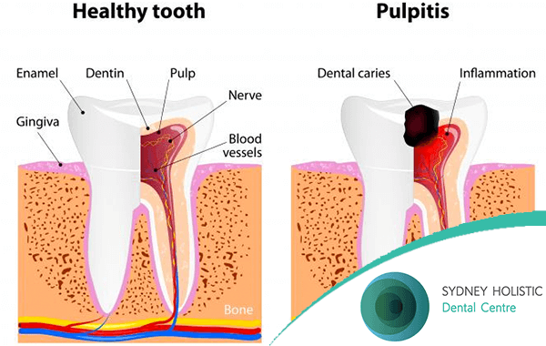 The Link Between Vitamin Deficiency And Tooth Decay