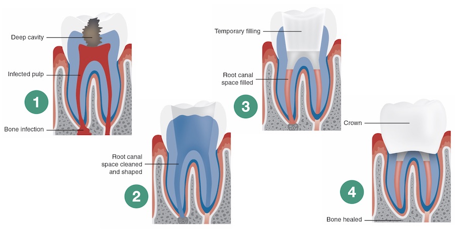 Root Canal Treatment