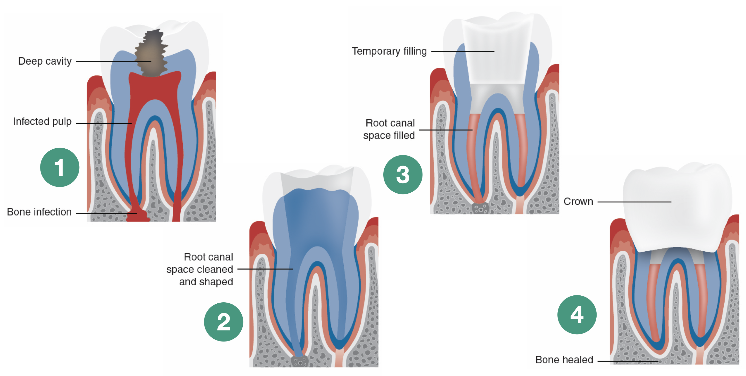 Root canal treatment