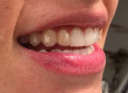Invisalign Clear Braces