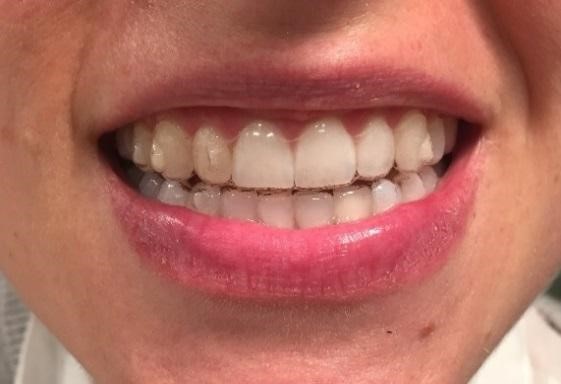 Invisalign Clear Braces