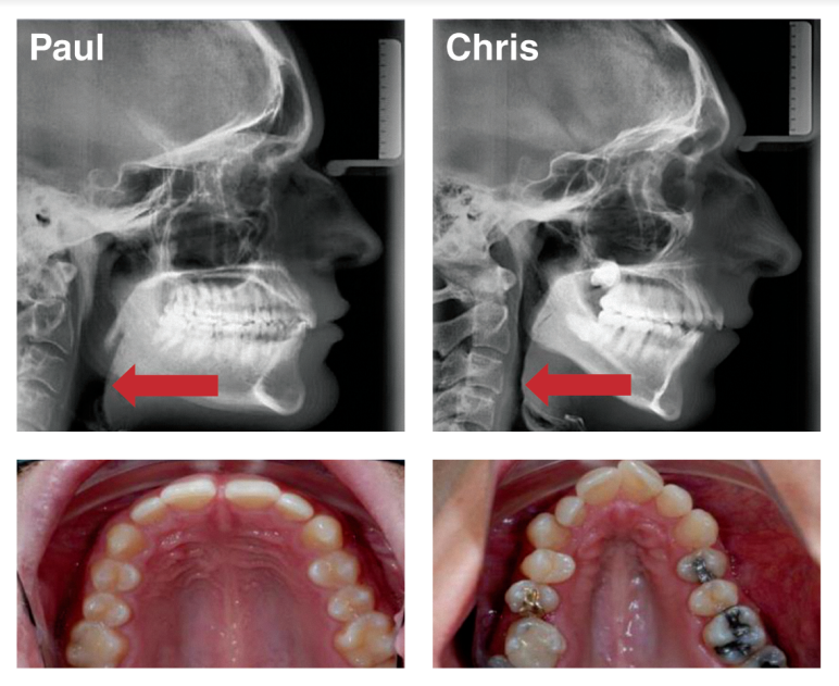 Invisalign Clear Braces