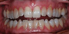 Teeth Whitening