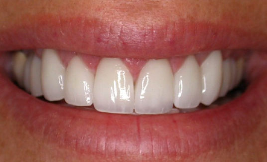 Porcelain Veneers