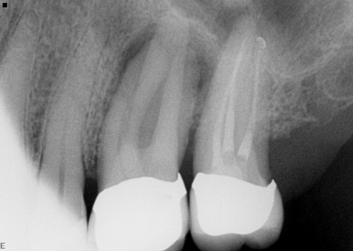 Internal Resorption After Root Canal – JLQSS