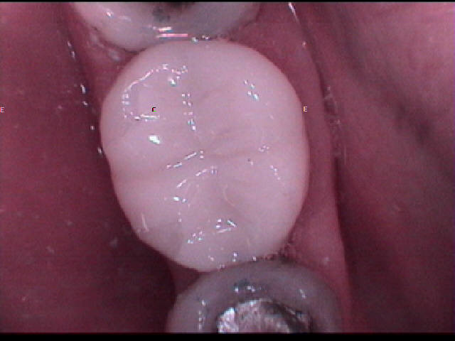 mercury amalgam removal