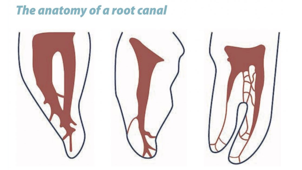 The Case for and Against a Root Canal Treatment