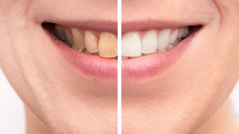 Holistic teeth whitening