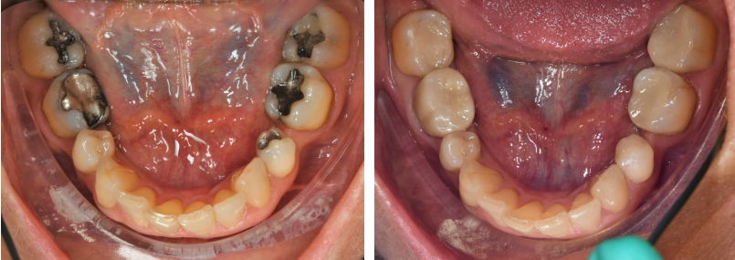 Mercury Amalgam Detoxification: <br>Nutritional &#038; Supplement Support