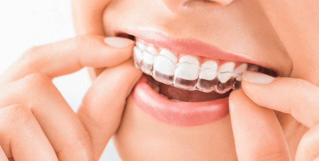 Invisalign clear aligners