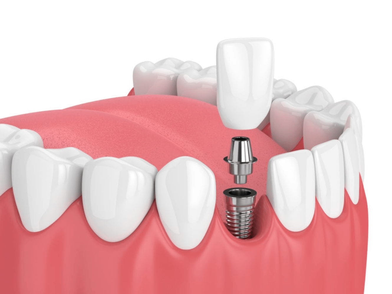 Single Dental Implant