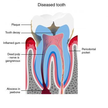 Root Canal Treatment