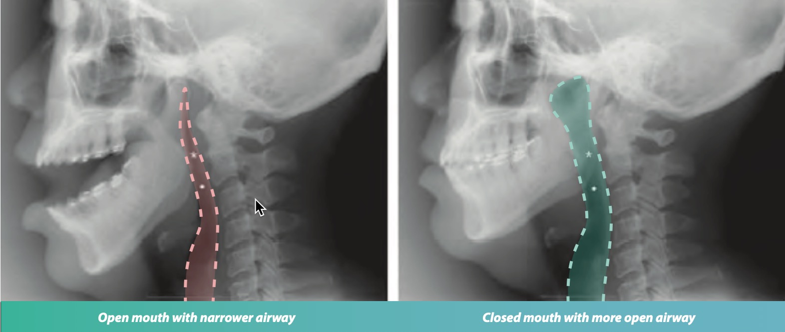 Nasal breathing