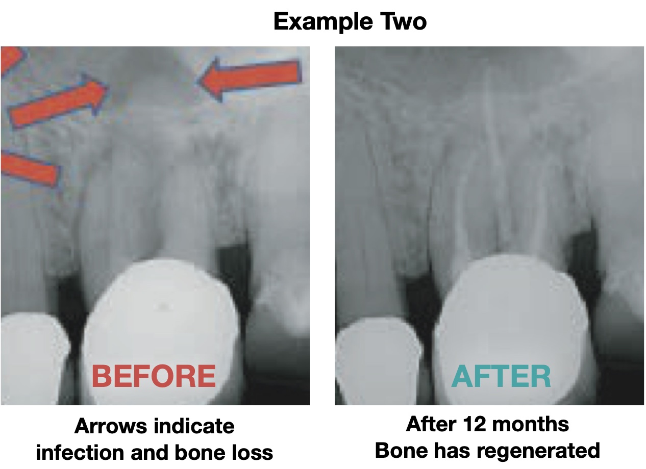 Root Canal Treatment