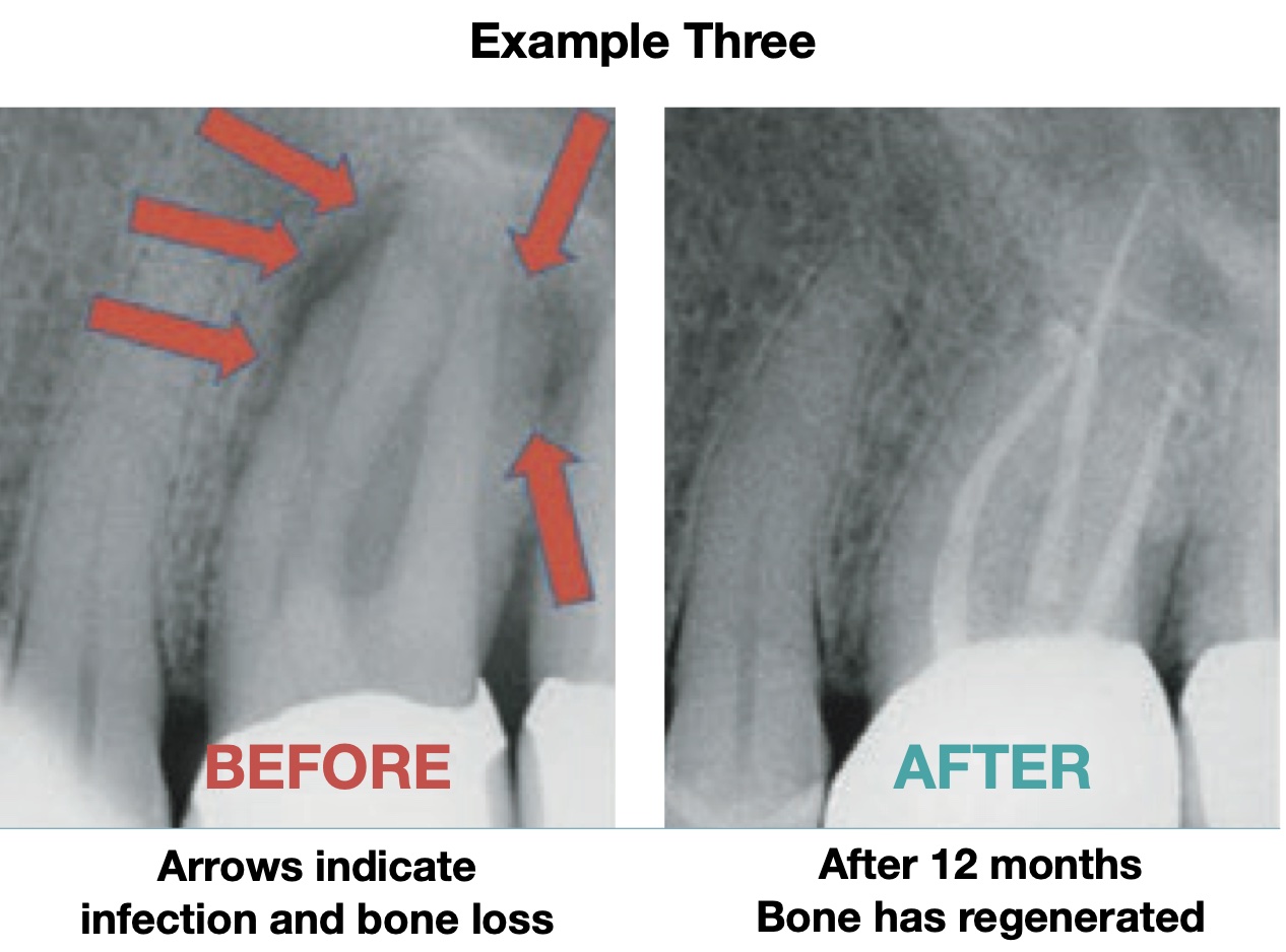 Root Canal Treatment