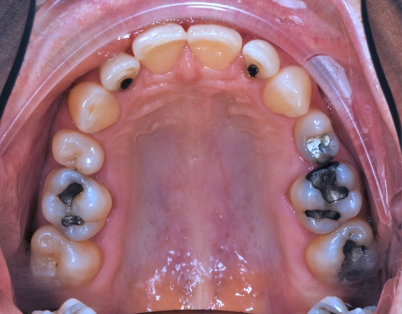 Dental Mercury Amalgam Filling Removal