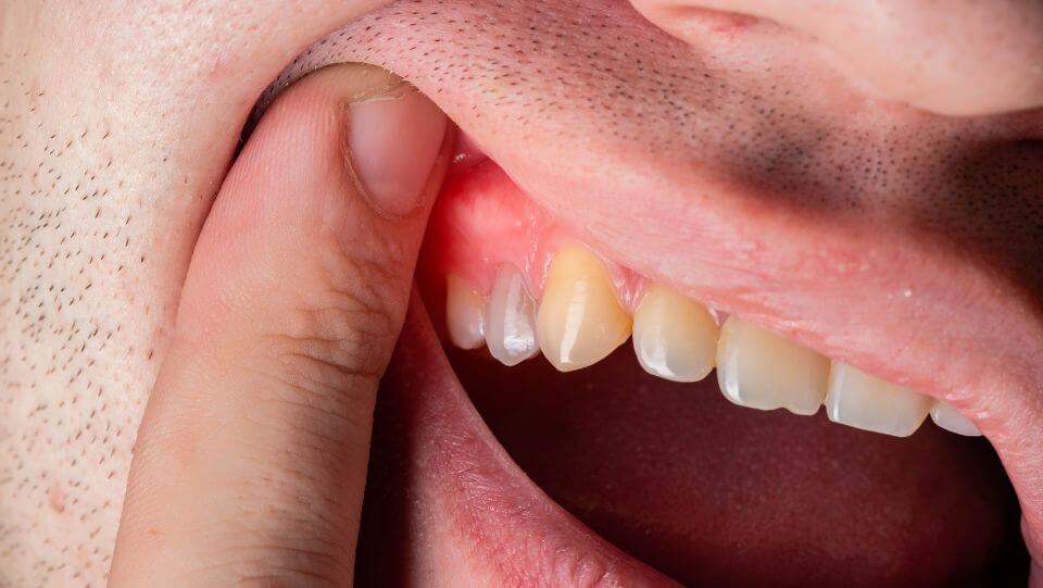 Periodontal Disease