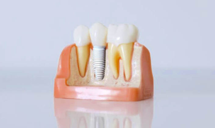 Zirconia implant