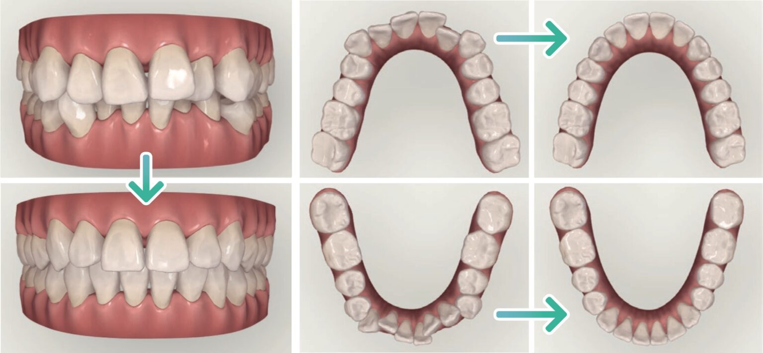 Invisalign Before and After treatment