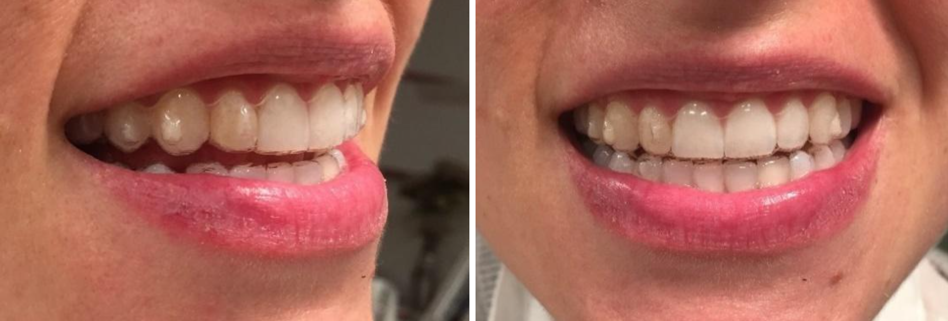 Invisalign for teeth straightening and alignment at SHDC