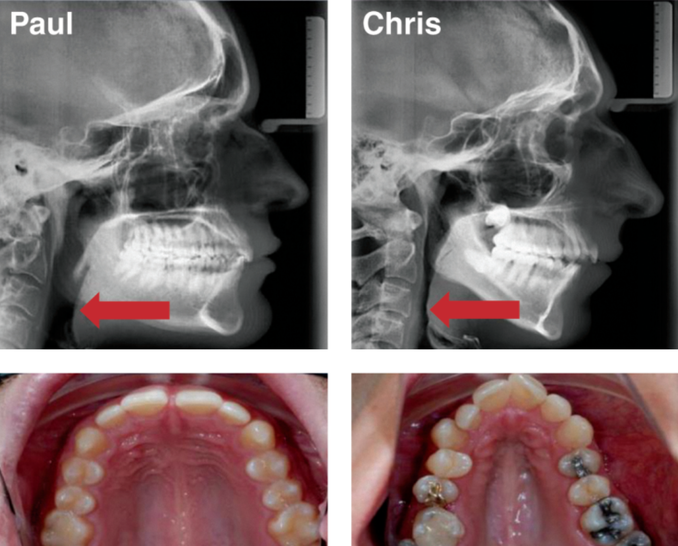 Invisalign Clear Braces