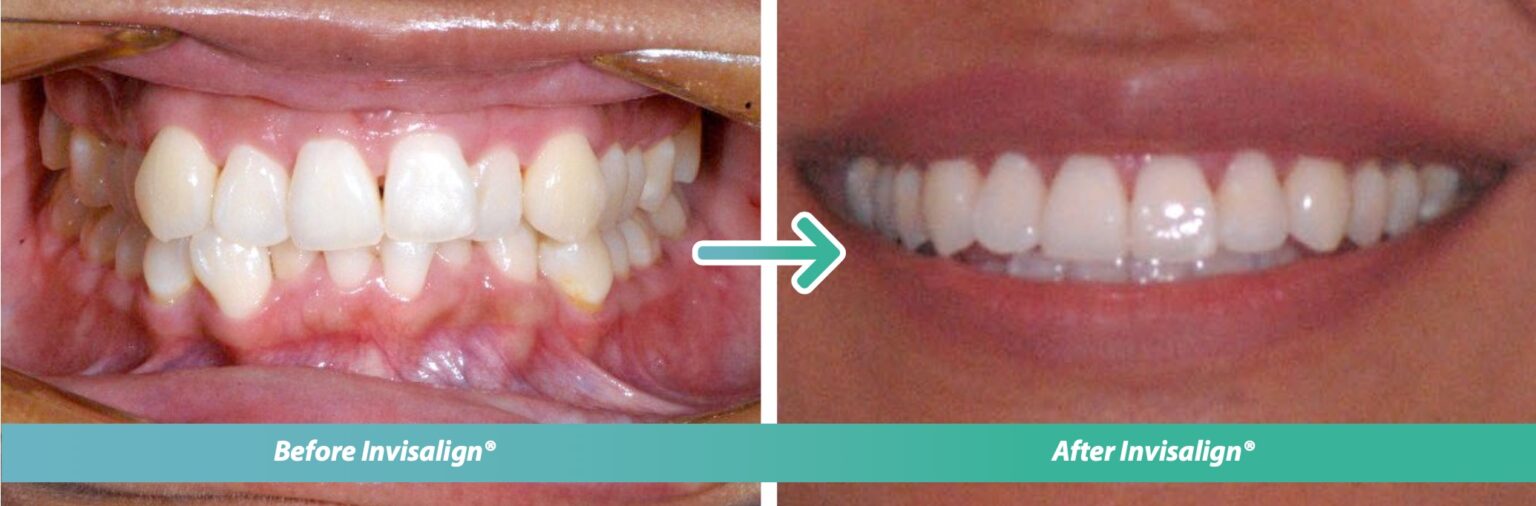 Invisalign before and after treatment