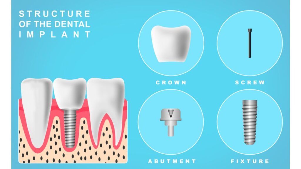Do Dental Implants Need to Be Replaced? About their Longevity