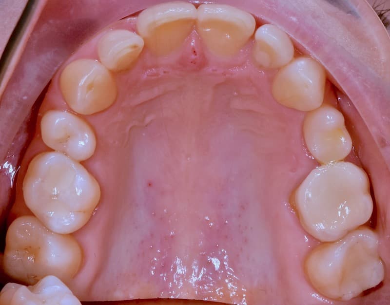 Amalgam after