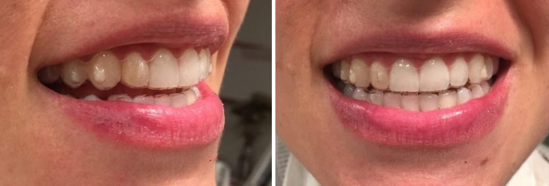 Invisalign for teeth straightening and alignment