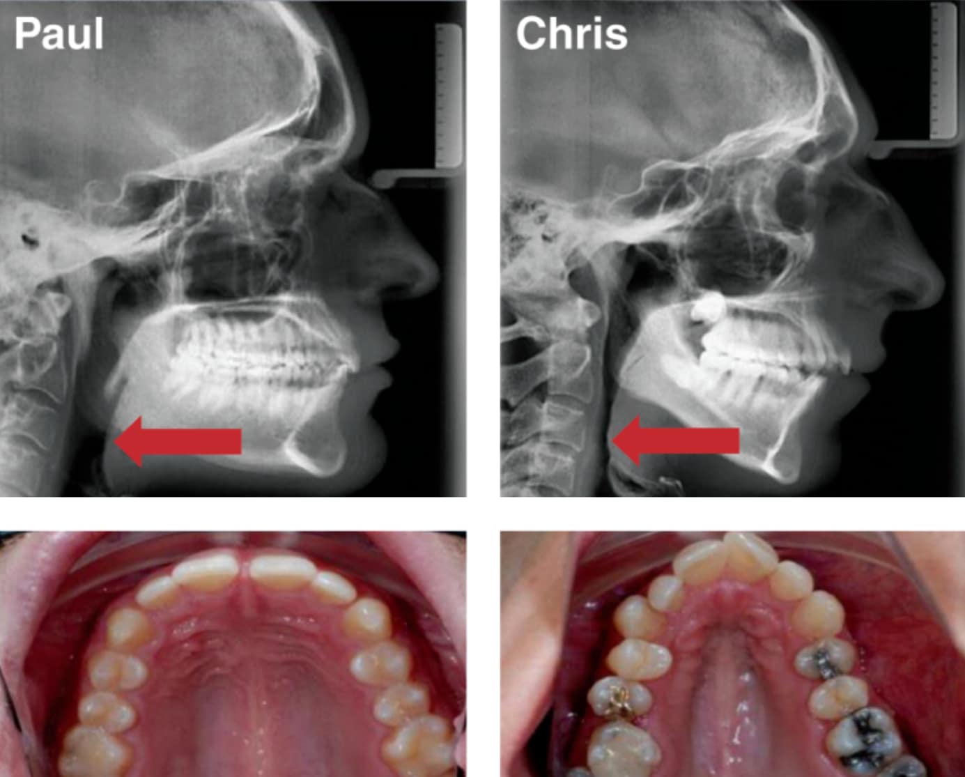 invisalign clear braces