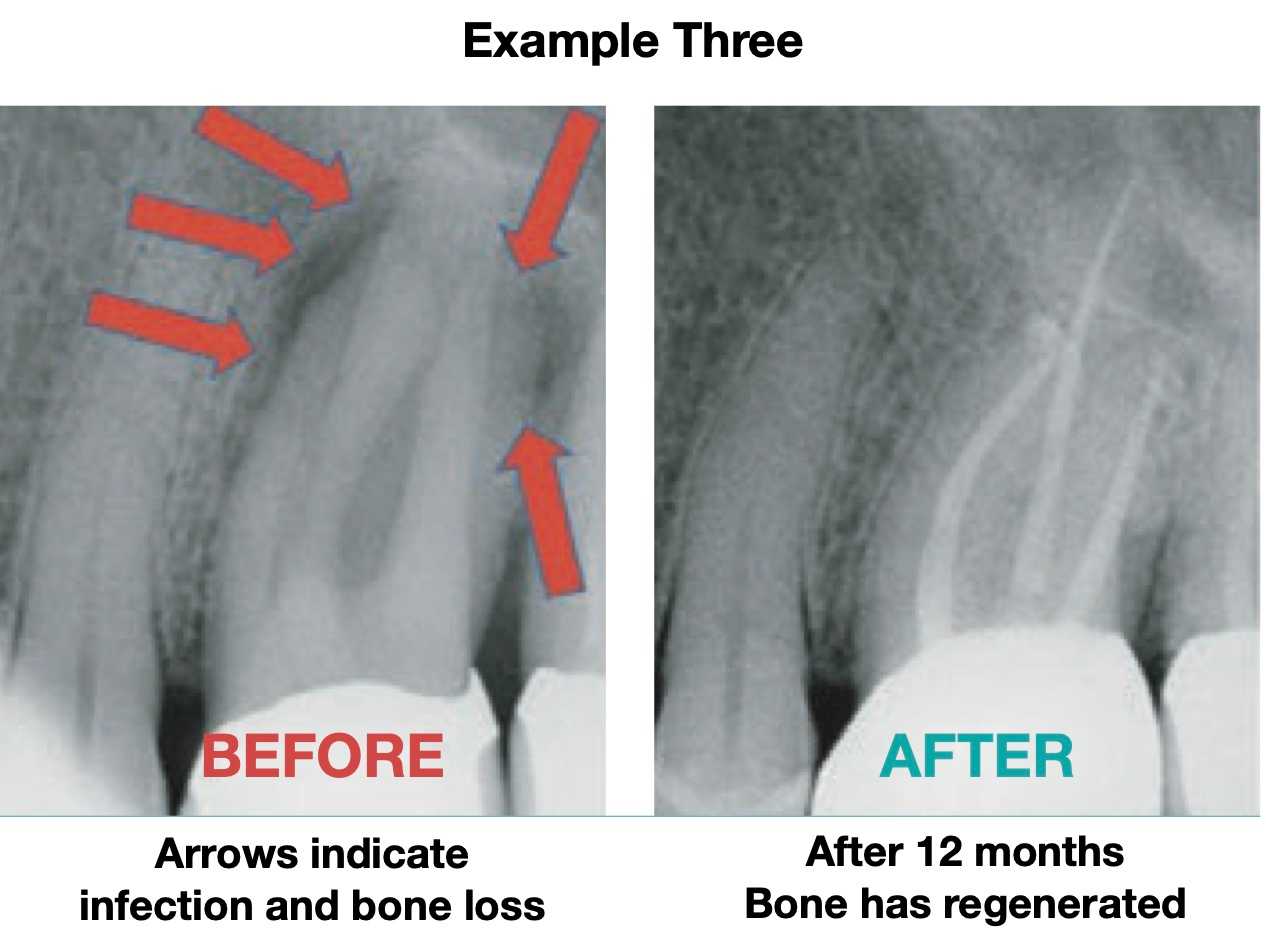 root canal example