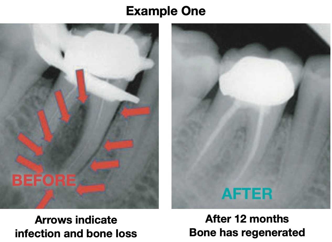 root canal explained