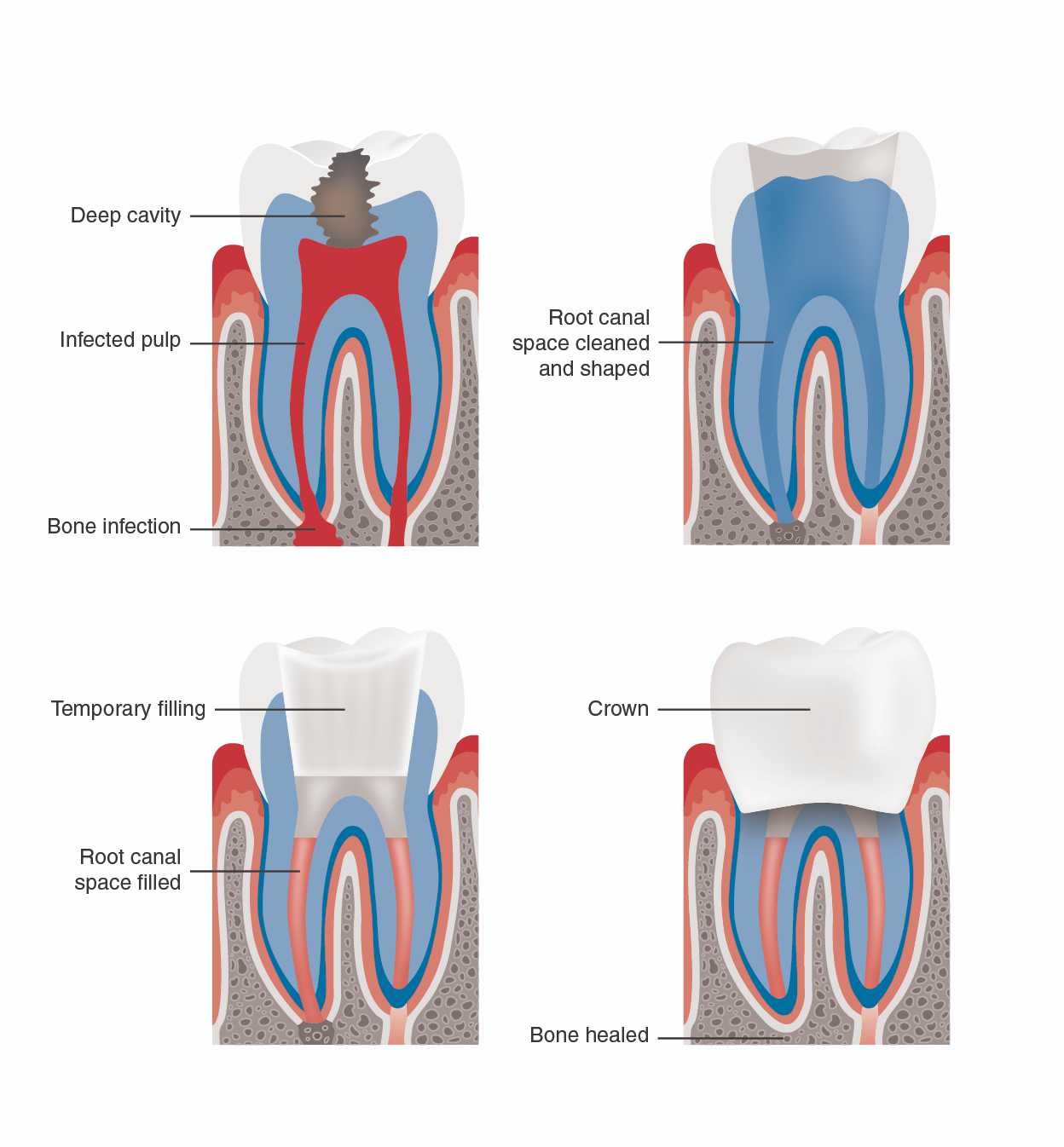 root canal treatment