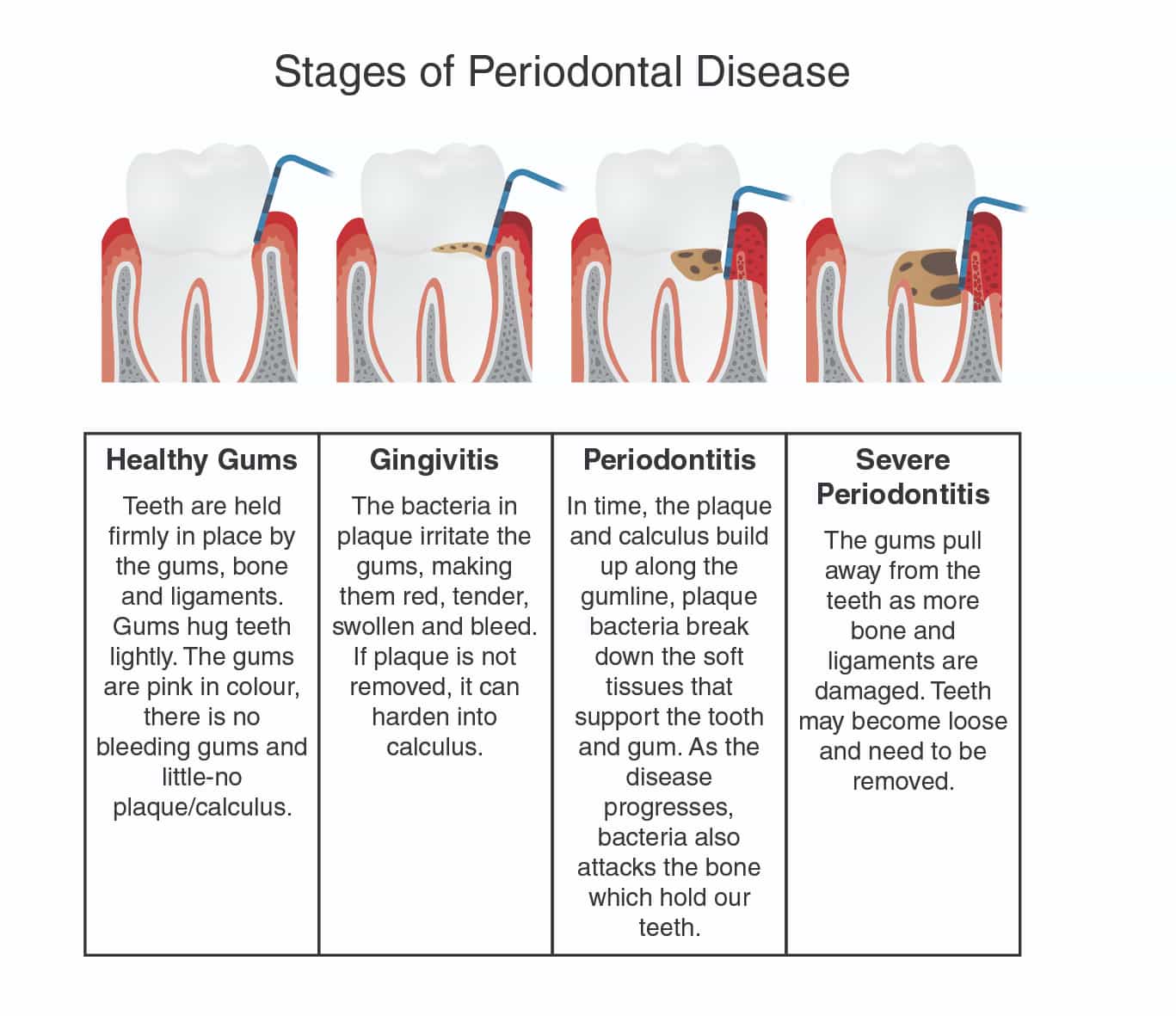 stages of periodontal disease
