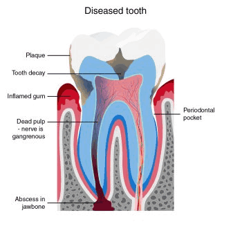 Diseased Tooth Anatomy