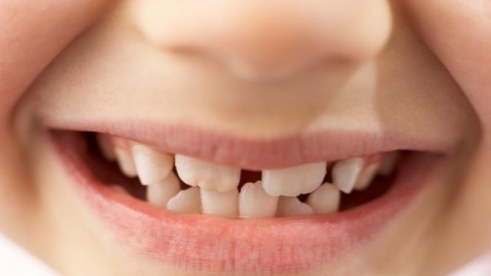 SHDC-FEATURED-IMAGE-2022-11-04T090334.63 myobraces